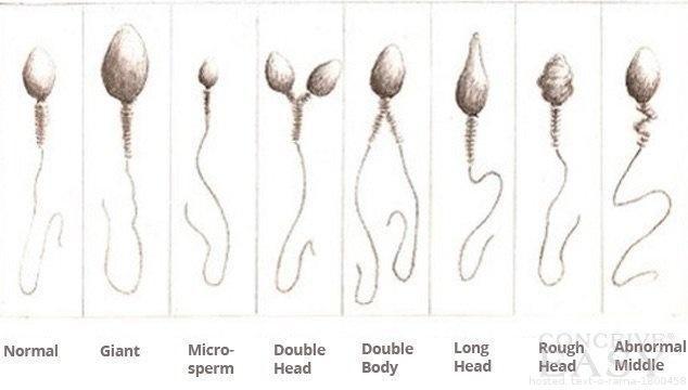 best of Sperm defects Male