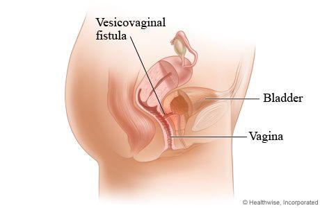 Lapis L. reccomend Having sex with a vaginal fistula