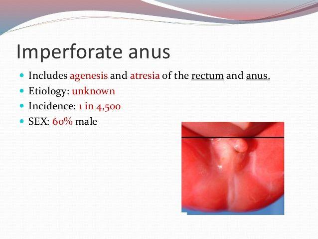 Aphrodite reccomend Etiology of imperforate anus