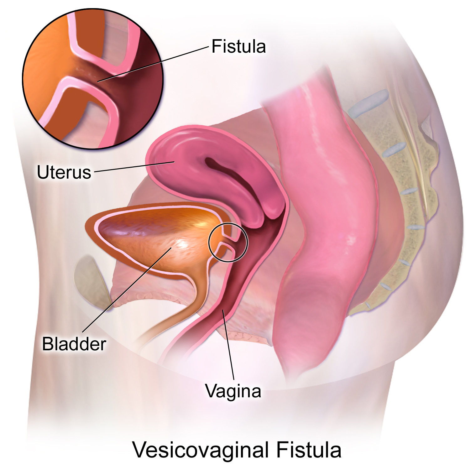best of Fistula a Having vaginal with sex