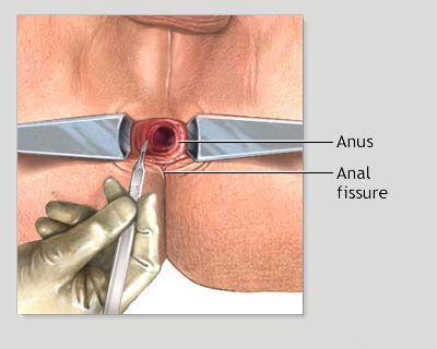 best of Fissure with hemorrhoid Anal
