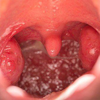 Adult group b strep throat infection diabetes