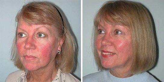 best of Surgery Restyline facial