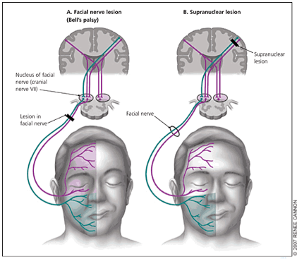 Gi-Gi reccomend Unilateral facial paralysis and otitis