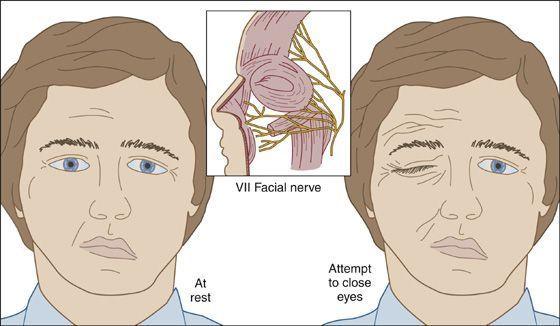 Woodshop reccomend Unilateral facial paralysis and otitis