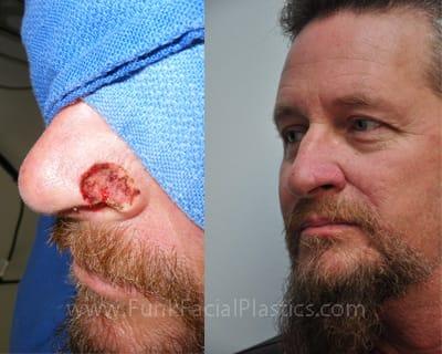 best of Surgery Facial skin grafting
