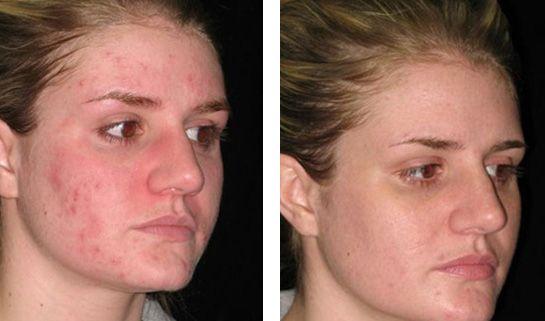 best of Redness treatment laser Facial