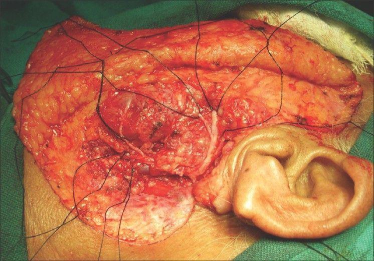 Winger reccomend Parotidectomy with facial nerve