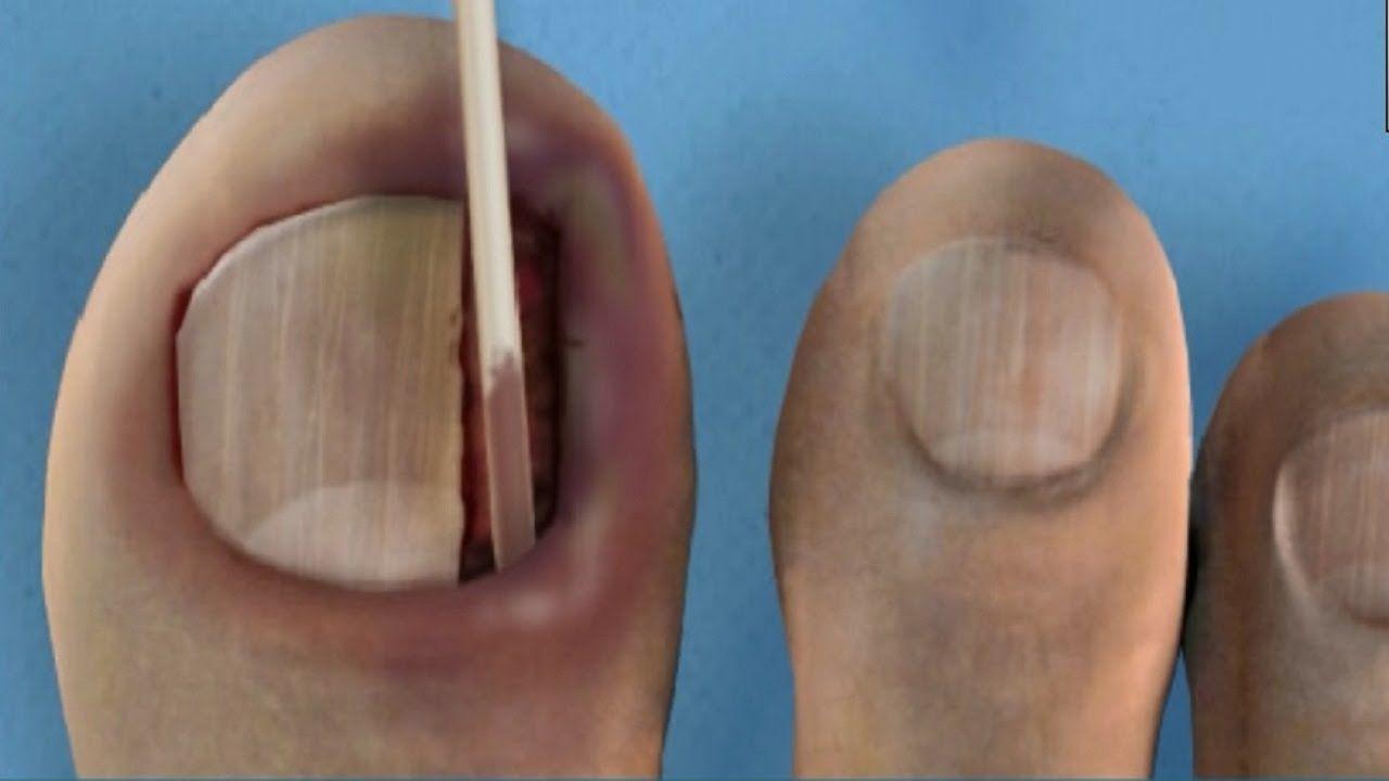 Fetish nail toe