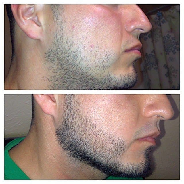 Lord C. reccomend Minoxidil facial hair growth