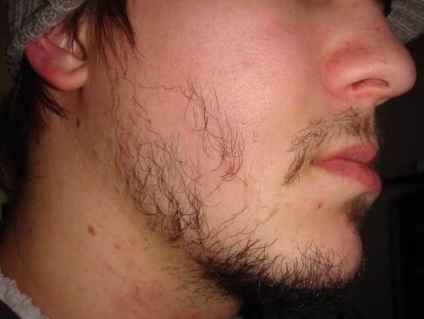 Tinkerbell reccomend Facial hair growth and girl