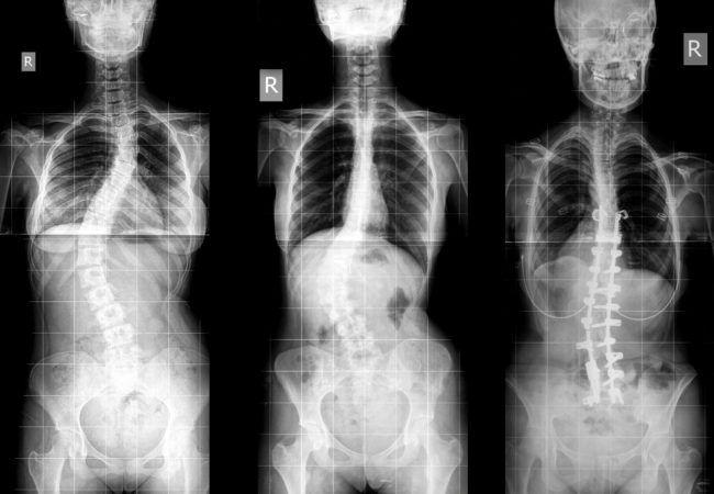 Mature adults with scoliosis