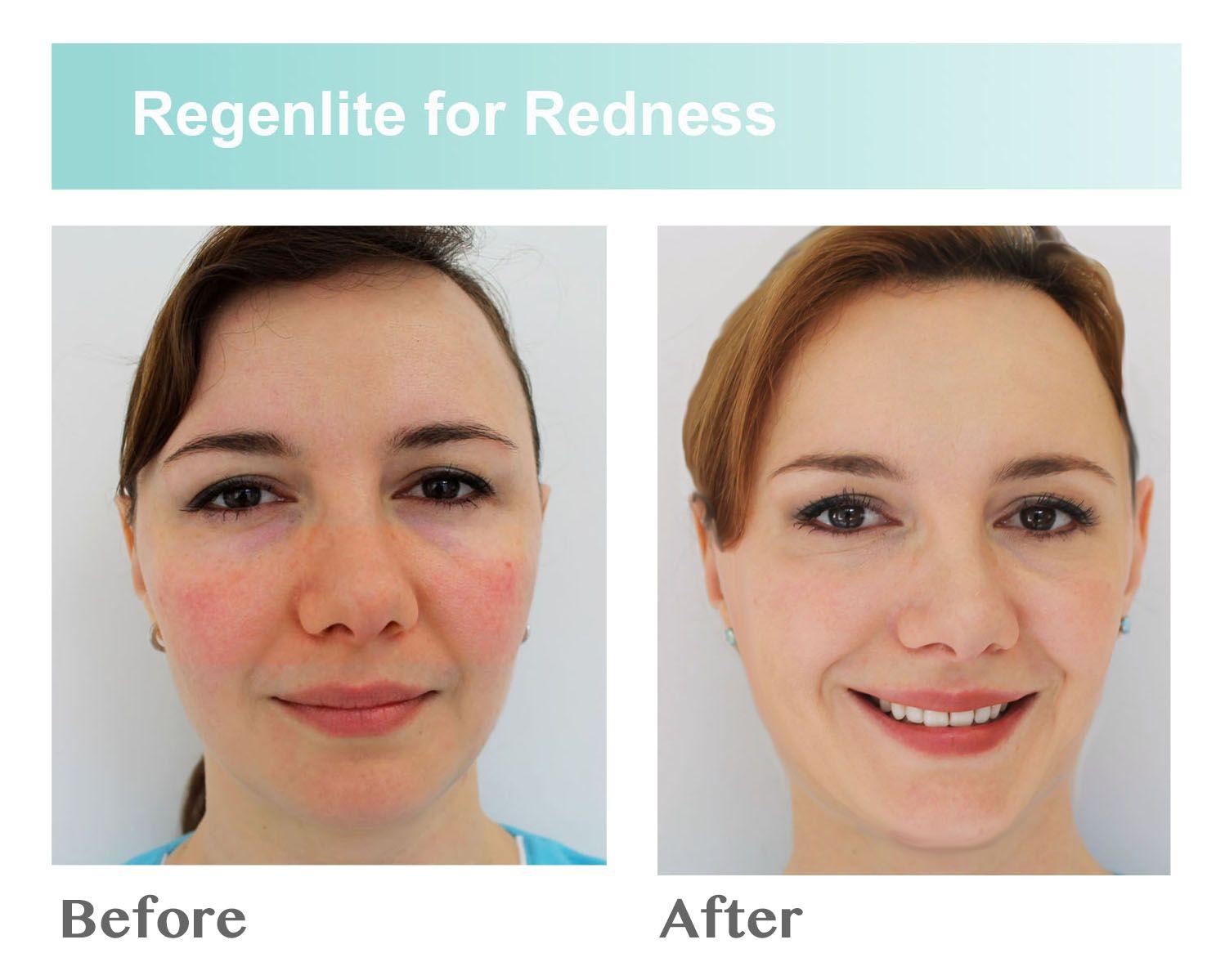 best of Redness treatment laser Facial