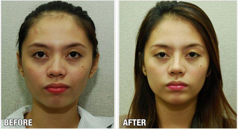 Facial gortex implant  photo