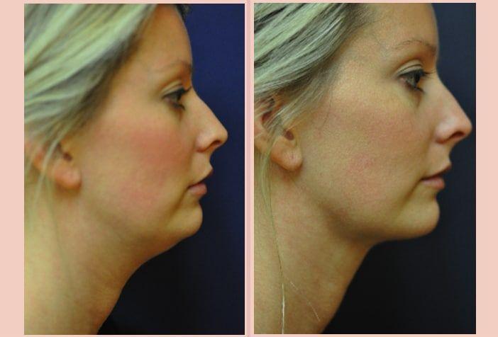 best of Garment chin Facial lipo after