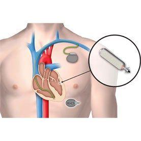 best of Penetrate lead surgery Pacemaker risk