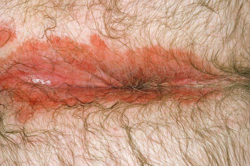 Cool-Whip reccomend Psoriasis on the anus pictures
