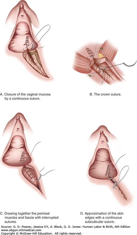 Crushing forceps picture vulva