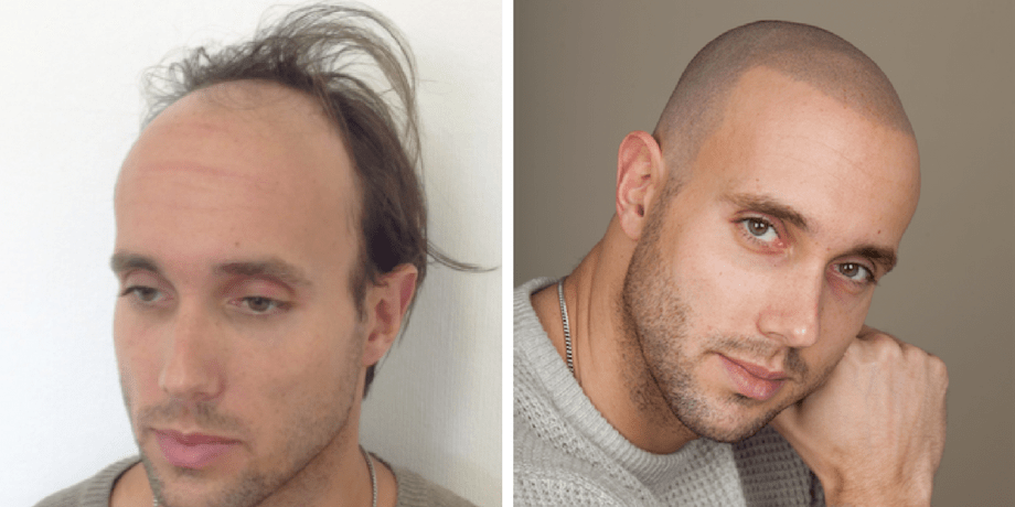 Twisty reccomend Shaved head before and after