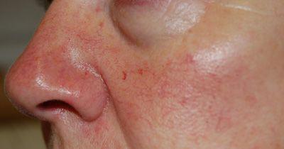 best of Capillaries broken Causes of facial