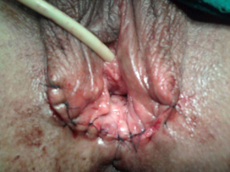 best of Skin vagina of Flaps in