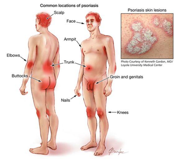 Psoriasis on the anus pictures