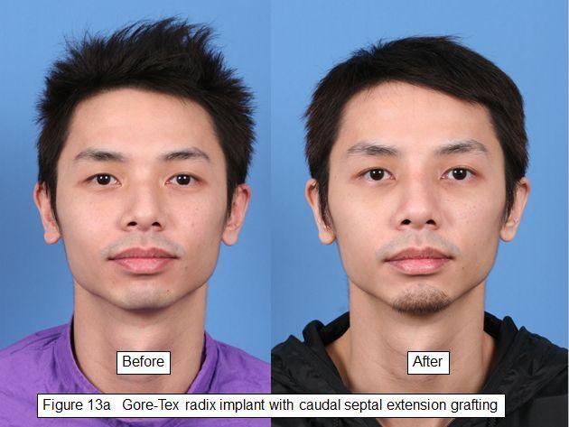 best of Implant Facial gortex
