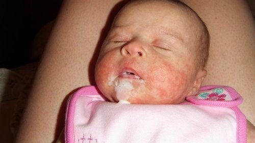 Baby facial rash pictures