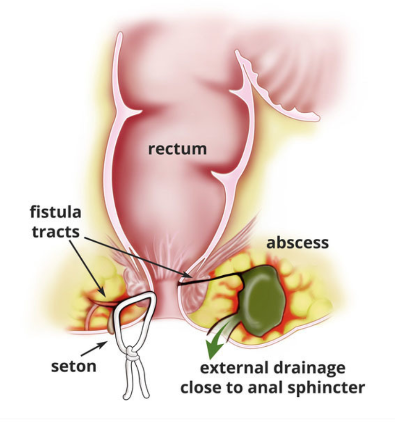 best of Recovery Anal fistulectomy