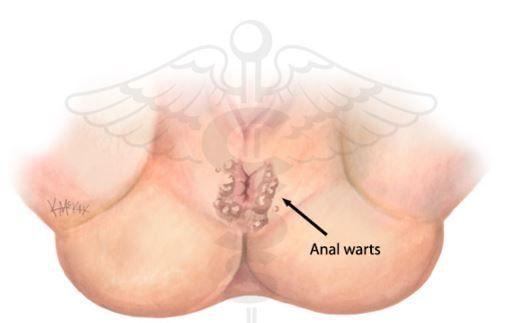 best of Picture Anus wart genital