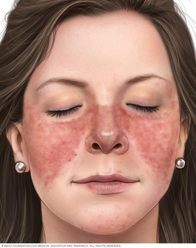 SWAT reccomend Lupus facial butterfly rash images