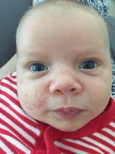 best of Pictures Baby facial rash