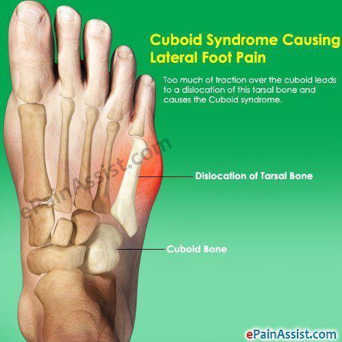 Jungle M. reccomend Pain in bottom lateral foot