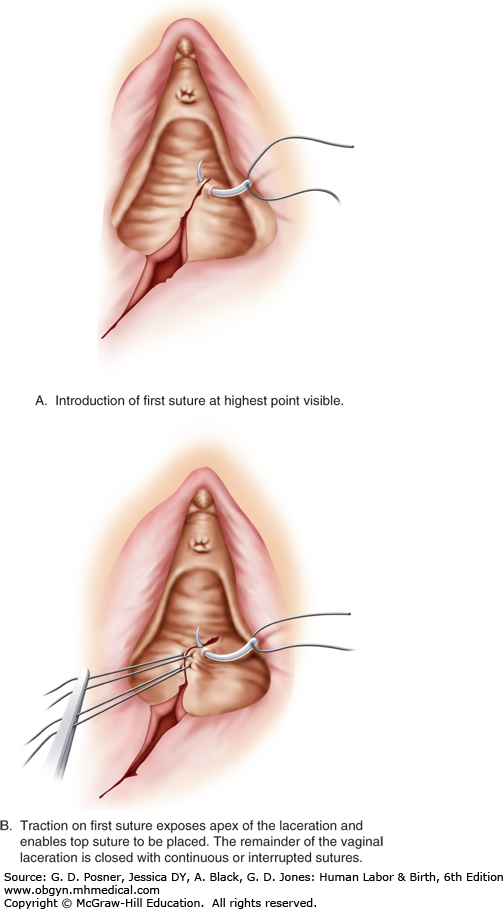 Crushing forceps picture vulva