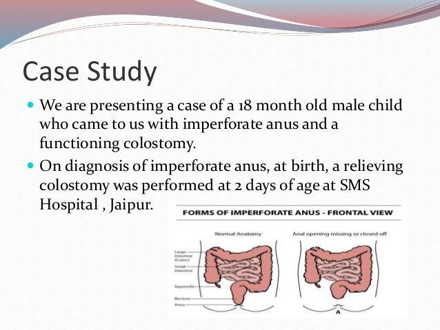Etiology of imperforate anus