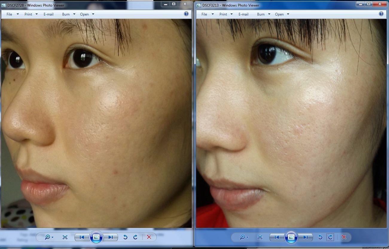 Bear reccomend Deep facial in picking resulted scar skin