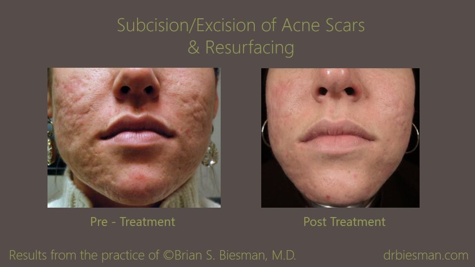Spider reccomend Deep facial in picking resulted scar skin