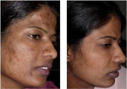 Discoloration facial skin