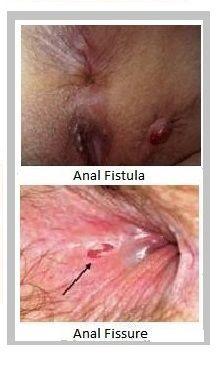 Anal fissure with hemorrhoid