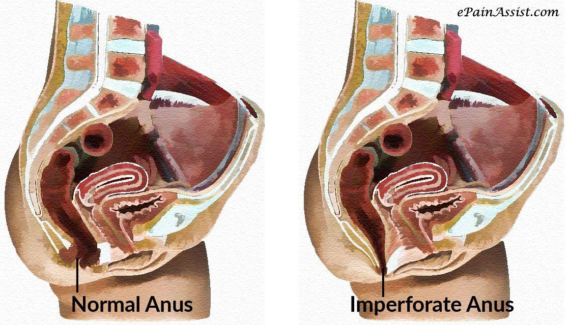 best of Imperforate Etiology anus of