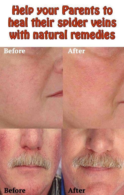 Getting rid of facial veins