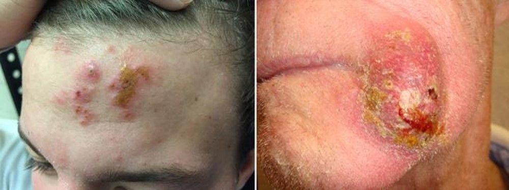 best of Hairs Infected facial