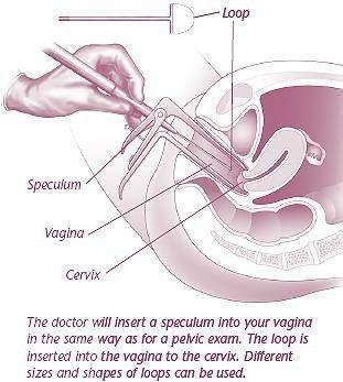 Leep of vulva