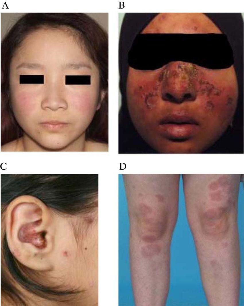 best of Rash Lupus images butterfly facial