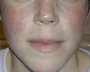 Lupus facial butterfly rash images