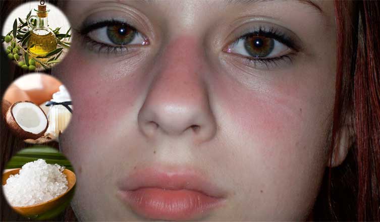 best of Rash Lupus images butterfly facial