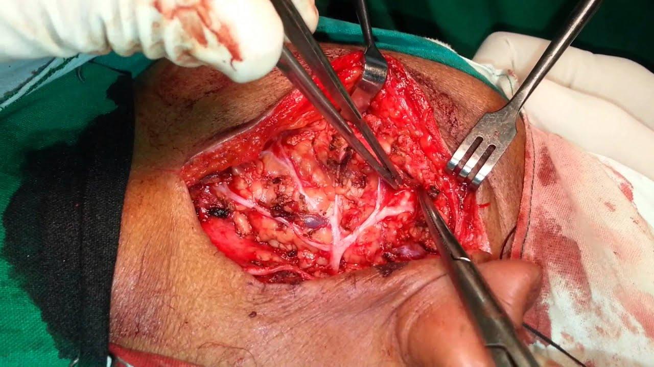Dragonfly reccomend Parotidectomy with facial nerve
