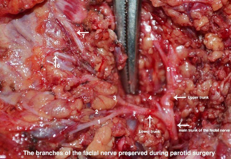 Handy M. reccomend Parotidectomy with facial nerve