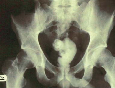 Hemmorhoids anus diagram photo