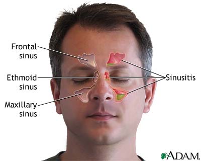 Winter reccomend Sinus and facial pain